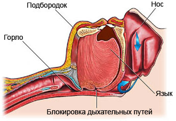 Атриовентрикулярный септальный дефект10