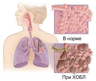Первичная легочная артериальная гипертензия10