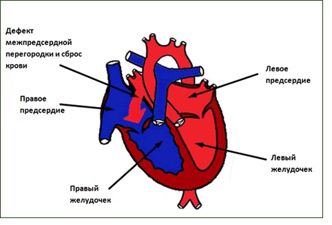 Единственный желудочек сердца10