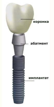 Реакция кости на имплантат10