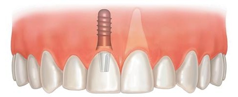 Имплантация одиночных зубов7