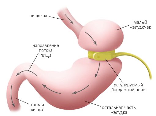 Ожирение11