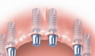 Имплантация верхней челюсти при частичном отсутствии зубов