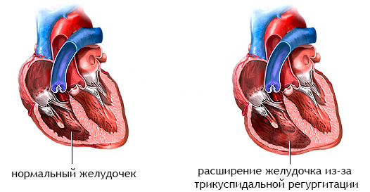 Лечение АВСД (атриовентрикулярного септального дефекта)14