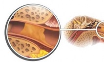 Серная пробка в ухе: симптомы