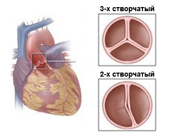 Транспозиция магистральных сосудов: операция, этапы, последствия18