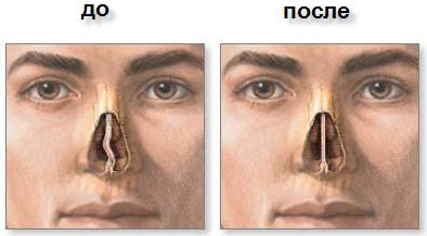 История ринопластики1