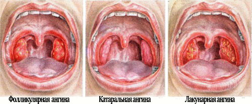 Ангина у детей1