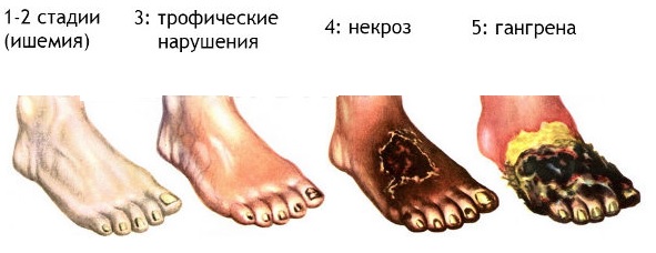 Гангрена1