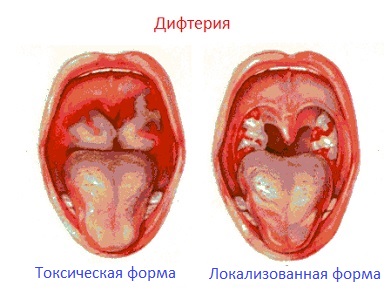 Дифтерия1