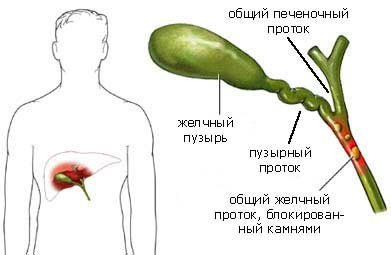 Опухоли желчных протоков