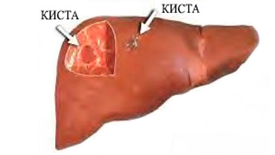 Киста печени: причины, лечение, диагностика, последствия