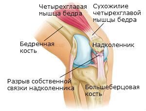 Повреждение связки надколенника1