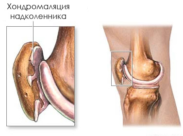 Хондромаляция надколенника1