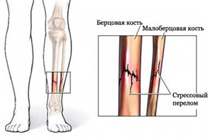Перелом малоберцовой и большеберцовой кости1