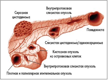 Ложная киста поджелудочной железы1
