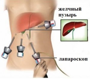 Лапароскопическая холецистэктомия1