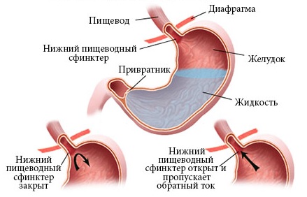 Лечение гастроэзофагеальной рефлюксной болезни1