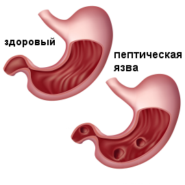 Торакоскопическая ваготомия1