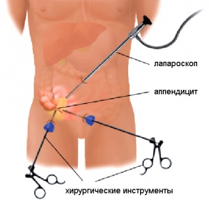 Лапароскопическая аппендэктомия1