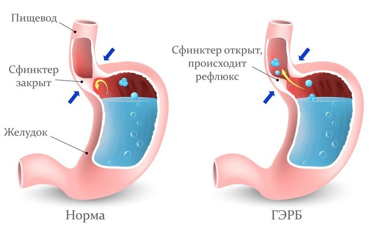 Хирургическое лечение гастроэзофагеальной рефлюксной болезни1