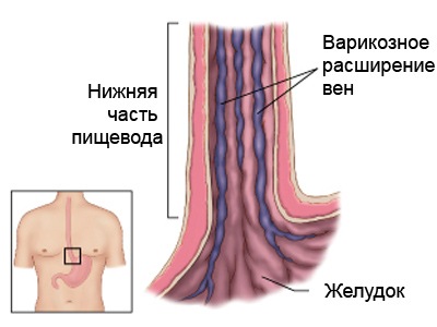 Эндоскопическая склеротерапия1