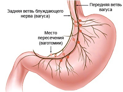 Лапароскопическая ваготомия1