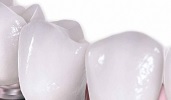 Имплантаты, соединенные с зубами