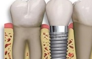 Имплантация одиночных зубов