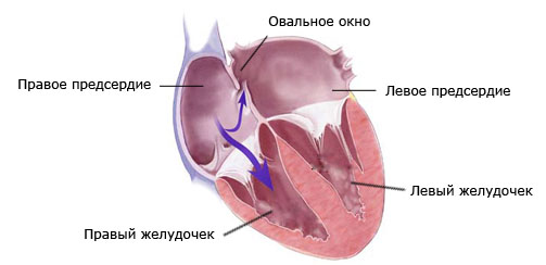 Вторичный дефект межпредсердной перегородки1