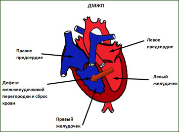 Клиника дефекта межжелудочковой перегородки1