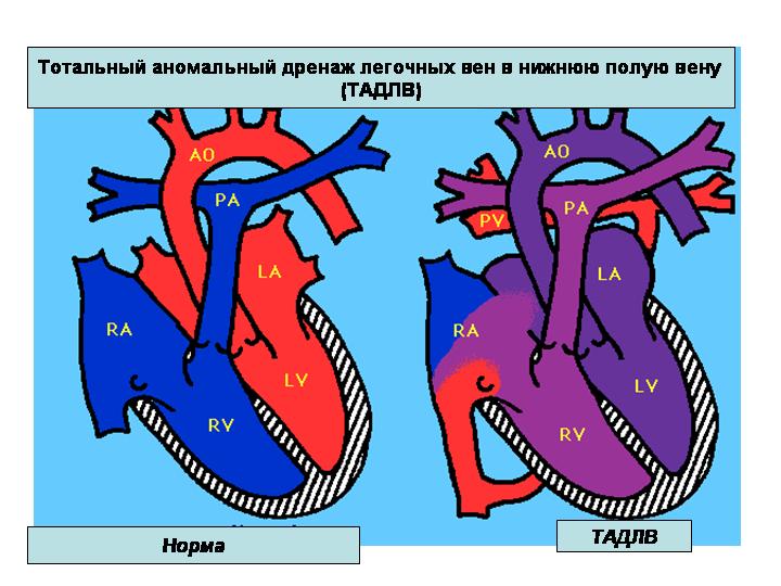Тотальный аномальный дренаж легочных вен (ТАДЛВ)1