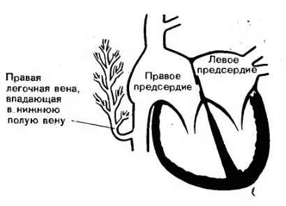 Аномалии легочных вен: лечение1