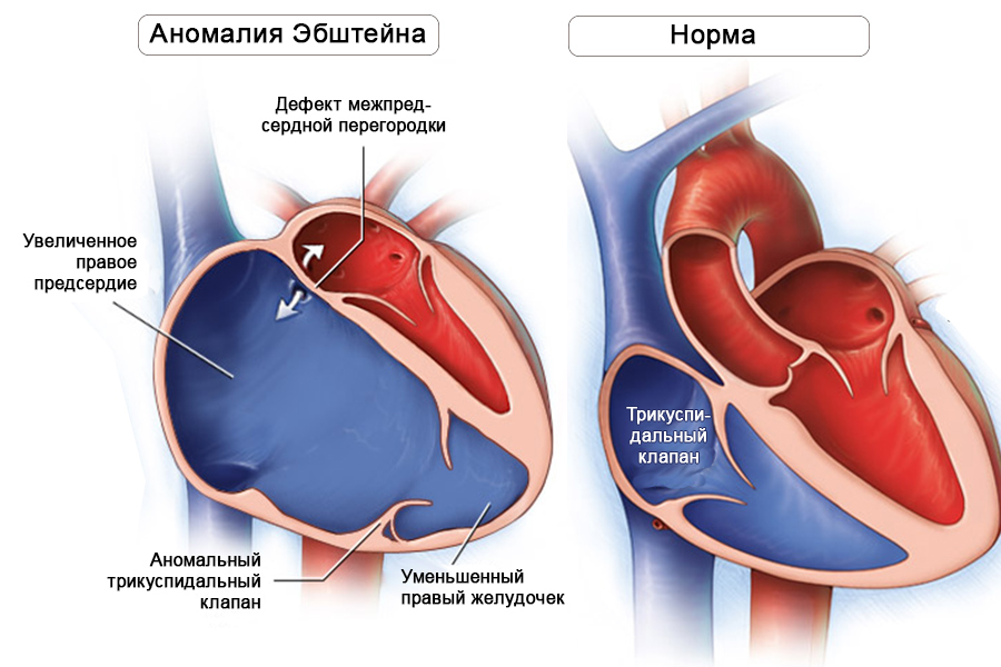 Аномалия Эбштейна1