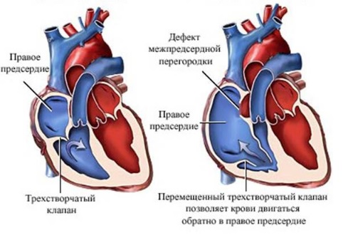 Врожденные пороки сердца1