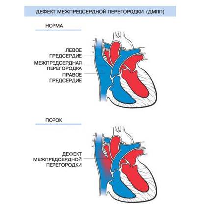 Врожденный дефект межжелудочковой перегородки1