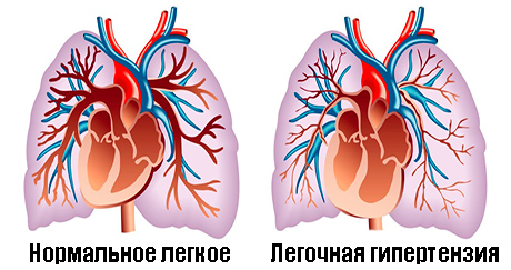 Морфология легочной гипертензии1