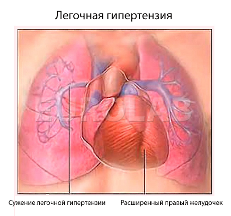 Диагностика и лечение легочной гипертензии1