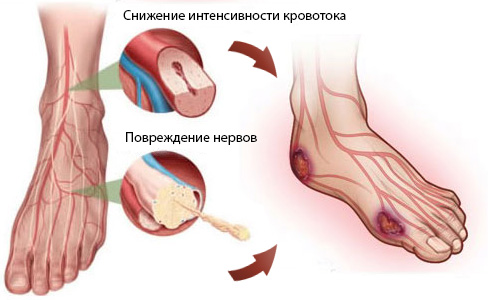 Синдром диабетической стопы1