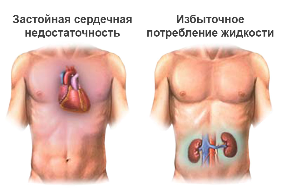 Несахарный диабет1