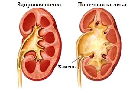 Почечная колика: симптомы, лечение1