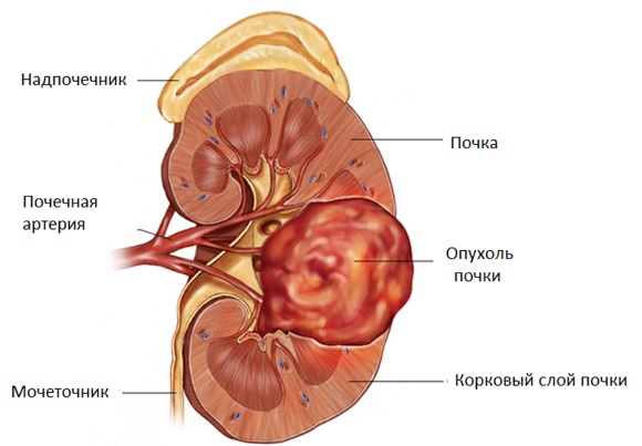 Рак почки: симптомы, диагностика, лечение, прогноз1