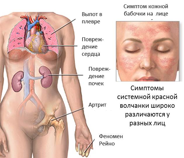 Системная красная волчанка1