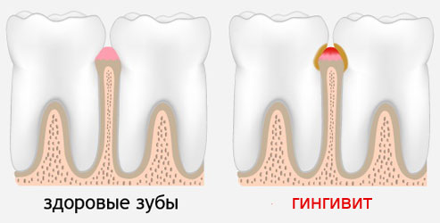 Гингивит: симптомы, лечение. Гингивит у беременных1