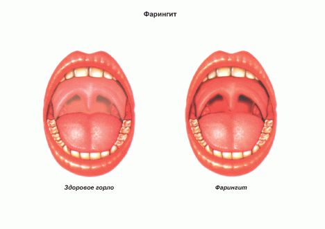 Лечение фарингита: народные средства или медикаментозное лечение1