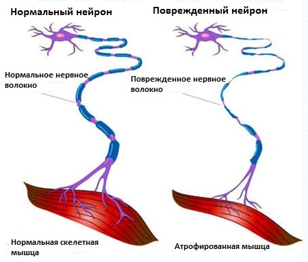 Боковой амиотрофический склероз: причины, симптомы, лечение1