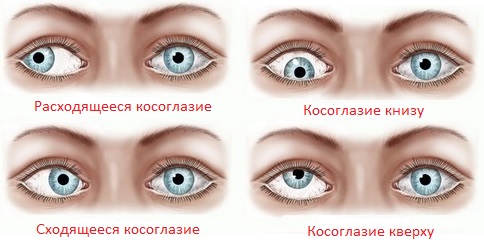 Косоглазие: причины, лечение1