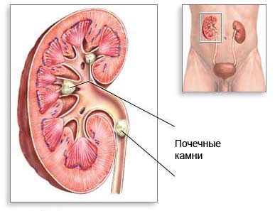 Половая жизнь при мочекаменной болезни. Лечение, последствия. 1