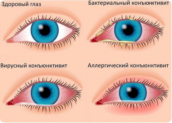 Вирусный конъюнктивит: симптомы, лечение1