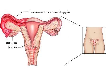 Лапароскопия маточных труб: показания, после операции1